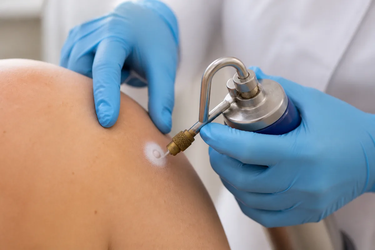 Cryotherapy for Minor Procedures